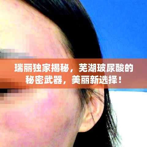 瑞麗獨(dú)家揭秘，蕪湖玻尿酸的秘密武器，美麗新選擇！