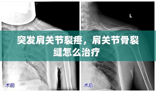 突發(fā)肩關(guān)節(jié)裂疼，肩關(guān)節(jié)骨裂縫怎么治療 