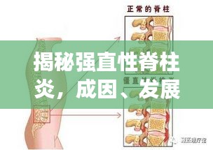 揭秘強(qiáng)直性脊柱炎，成因、發(fā)展與突發(fā)性的真相解析