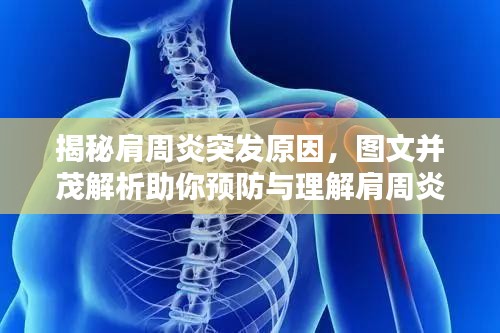 揭秘肩周炎突發(fā)原因，圖文并茂解析助你預(yù)防與理解肩周炎發(fā)作